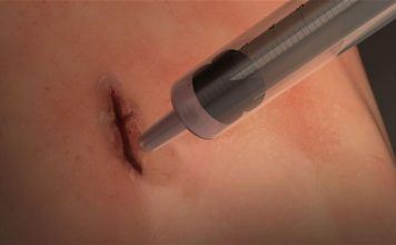 Engineers Develop Life-Saving Medical Glue